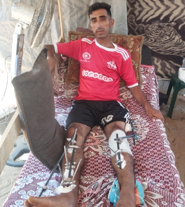 ابراهيم العرجا نجم فلسطيني أطفأت الحرب قدميه وأشعلت وجعه